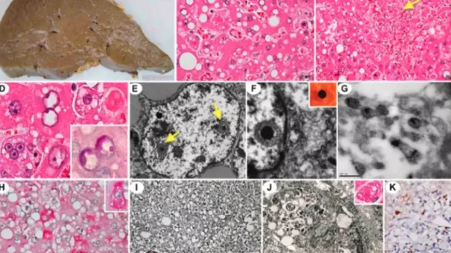 USP investiga ressurgimento do vírus sabiá após 20 anos