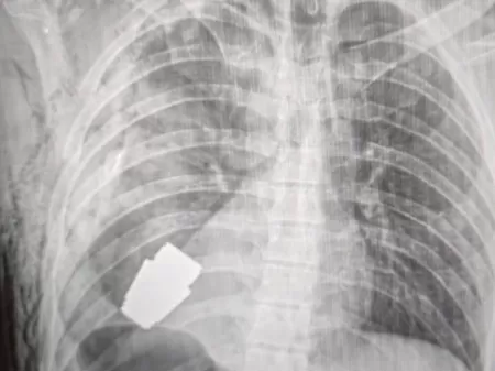 Médicos retiram granada não detonada alojada perto de coração de soldado