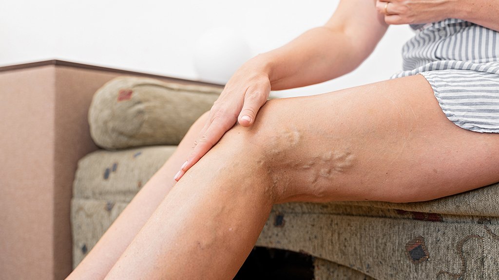 A cada dia, pelo menos 145 mulheres são internadas para tratamento de varizes no Brasil