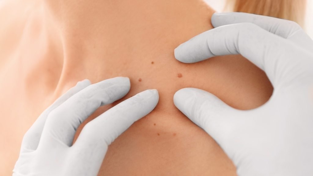 Câncer de pele: Nova vacina pode estar chegando e reduz o risco de morte