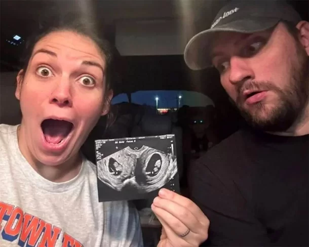 Mulher que nasceu com dois úteros está grávida nos dois ao mesmo tempo