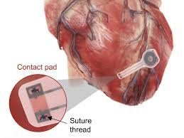 Novo marcapasso injetável some no corpo em 5 dias e funciona com celular