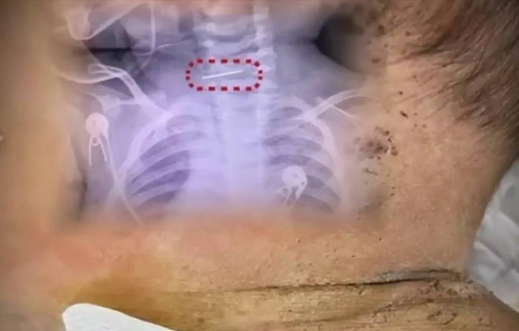 Mãe fura bebê mais de 600 vezes por ‘mau comportamento’ e agulha acaba presa na coluna cervical